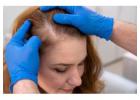 Non- Surgical Hair Replacement Dallas