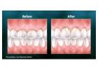 Summerlin Dental Care offers advanced laser dentistry that can transform your smile.